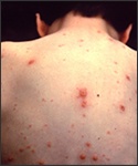 A picture of the back of a person with chickenpox spots on them