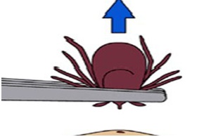 Tick Removal 2